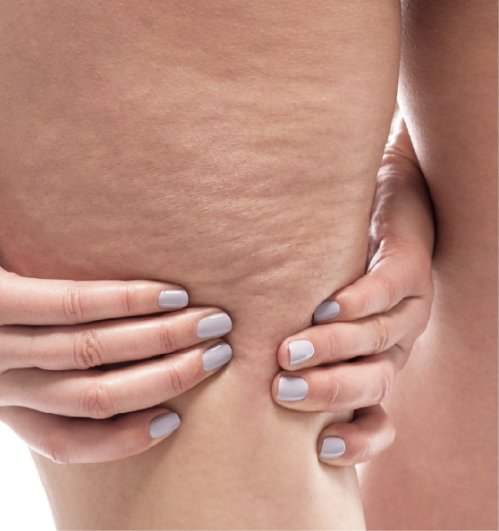 Celulitis yo Grasa Localizada