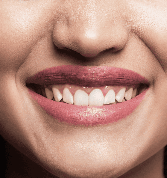 Sonrisa Gingival