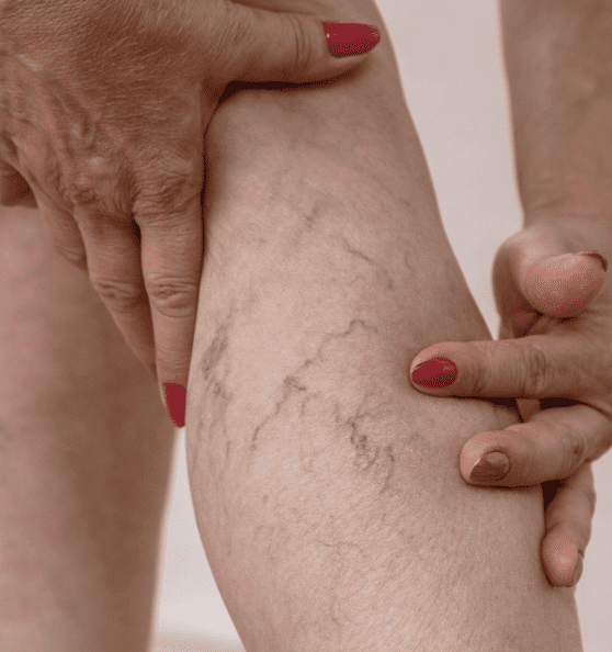 Escleroterapia Varices